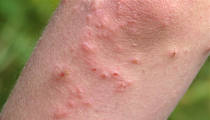 what does poison ivy look like on skin